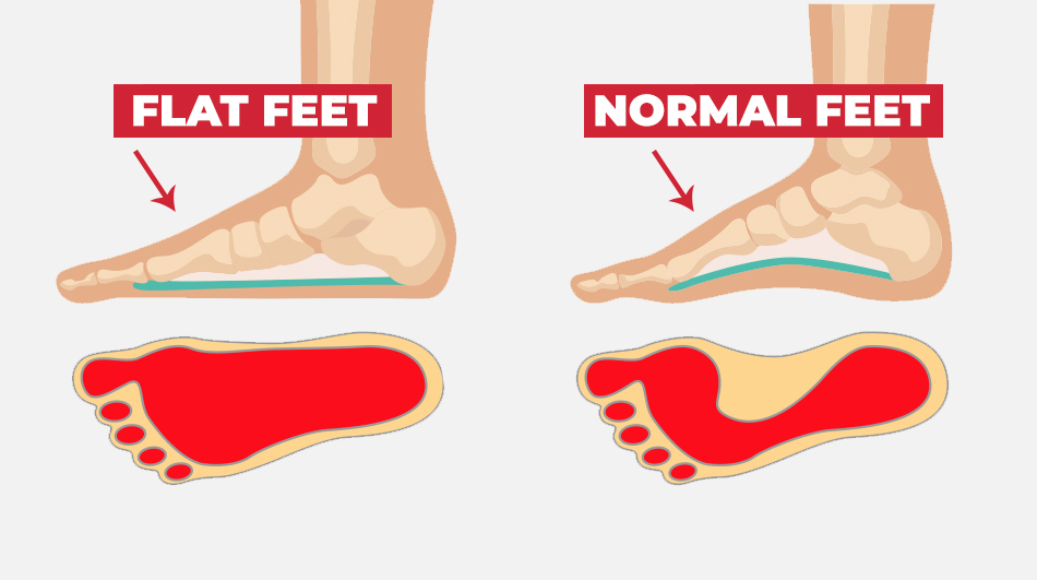 pain in bottom of heel after running